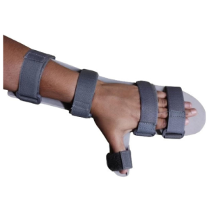 Static Cock-Up Splints
